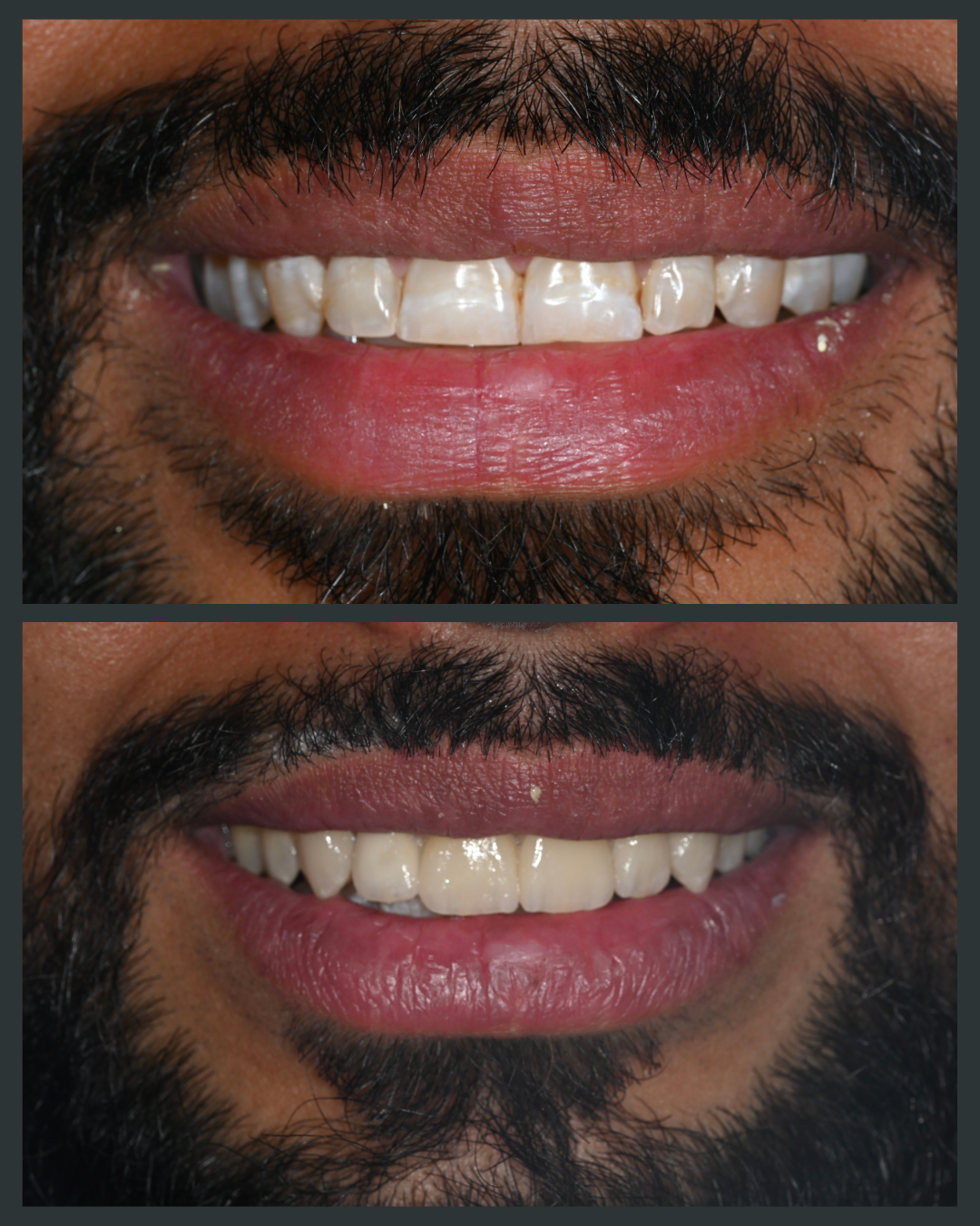 Illustration of complete smile makeover