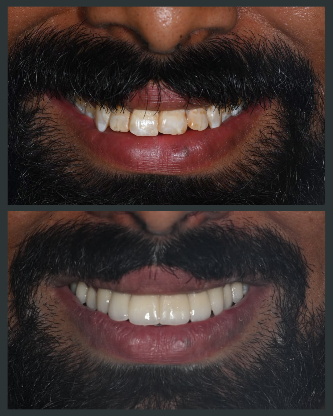 Illustration of discoloured or stained teeth