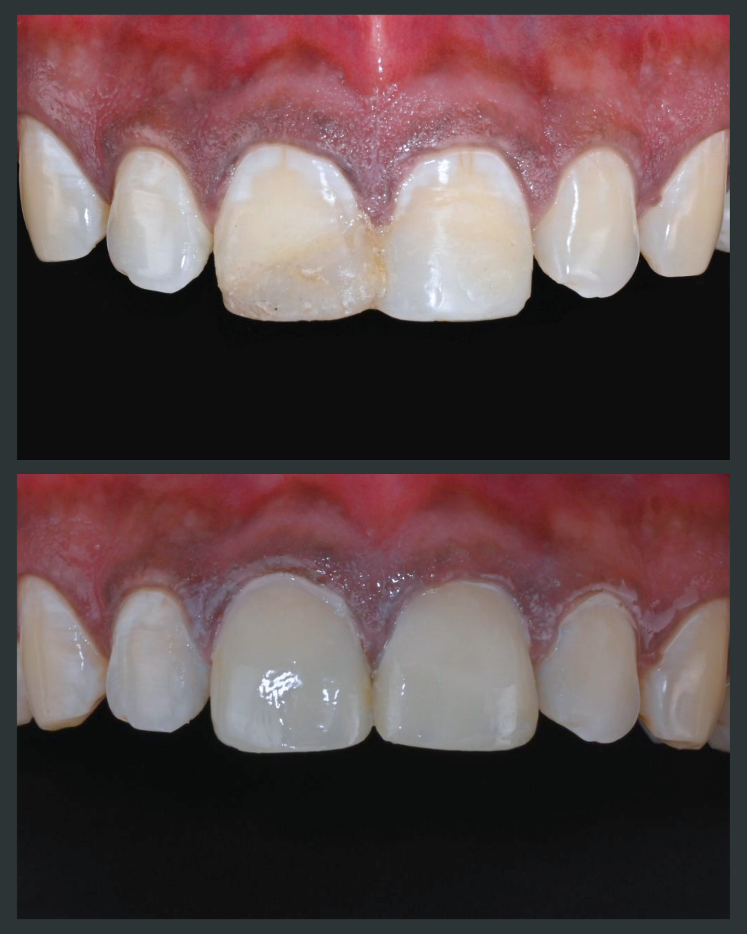 Illustration of old discoloured fillings or bonding