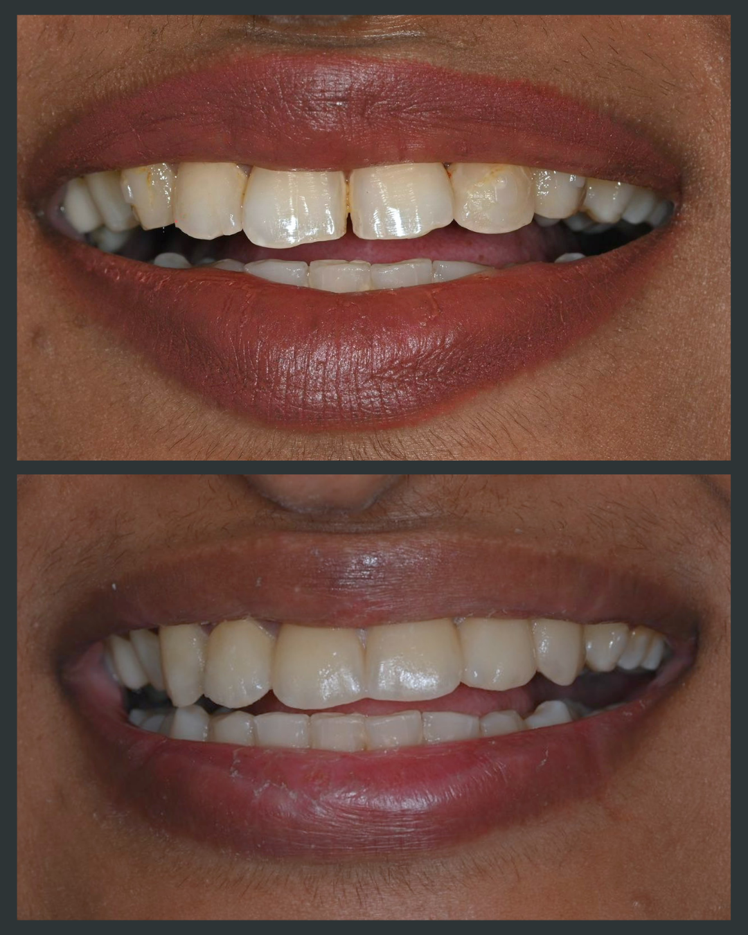 Illustration of uneven or irregularly shaped teeth