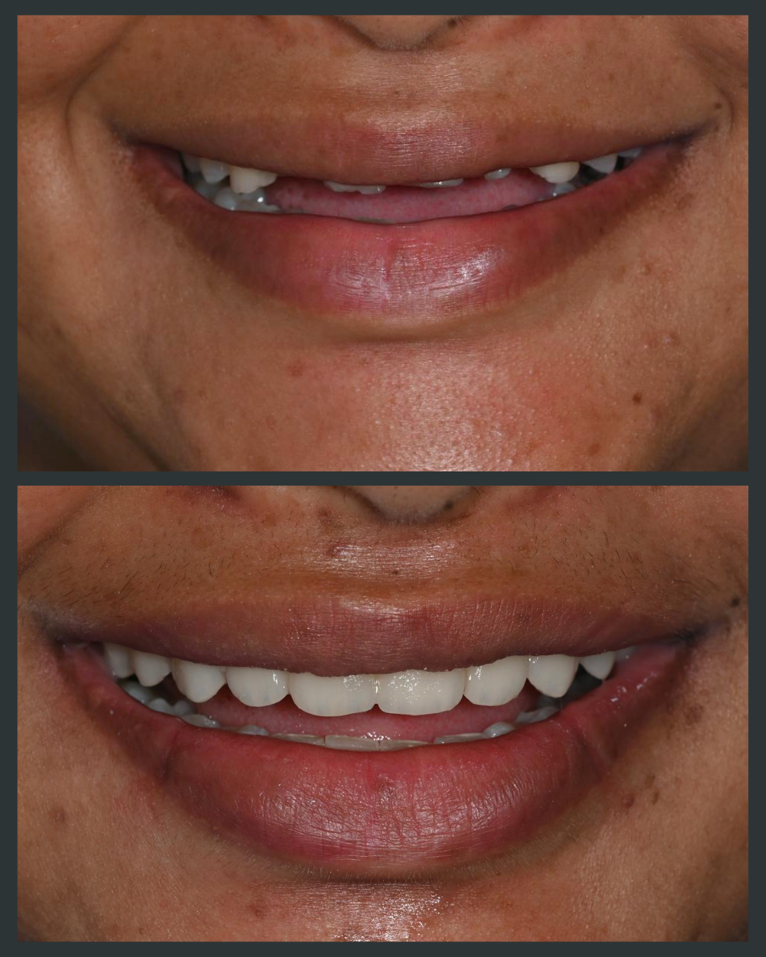 Illustration of worn or short front teeth