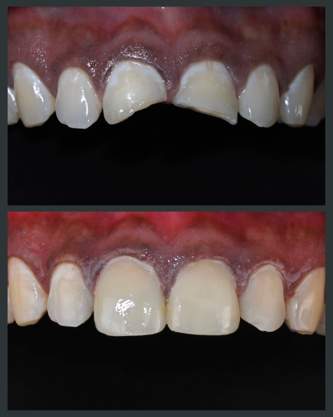 Veneers Before & After Result 2 at Floss-it Dental Clinic