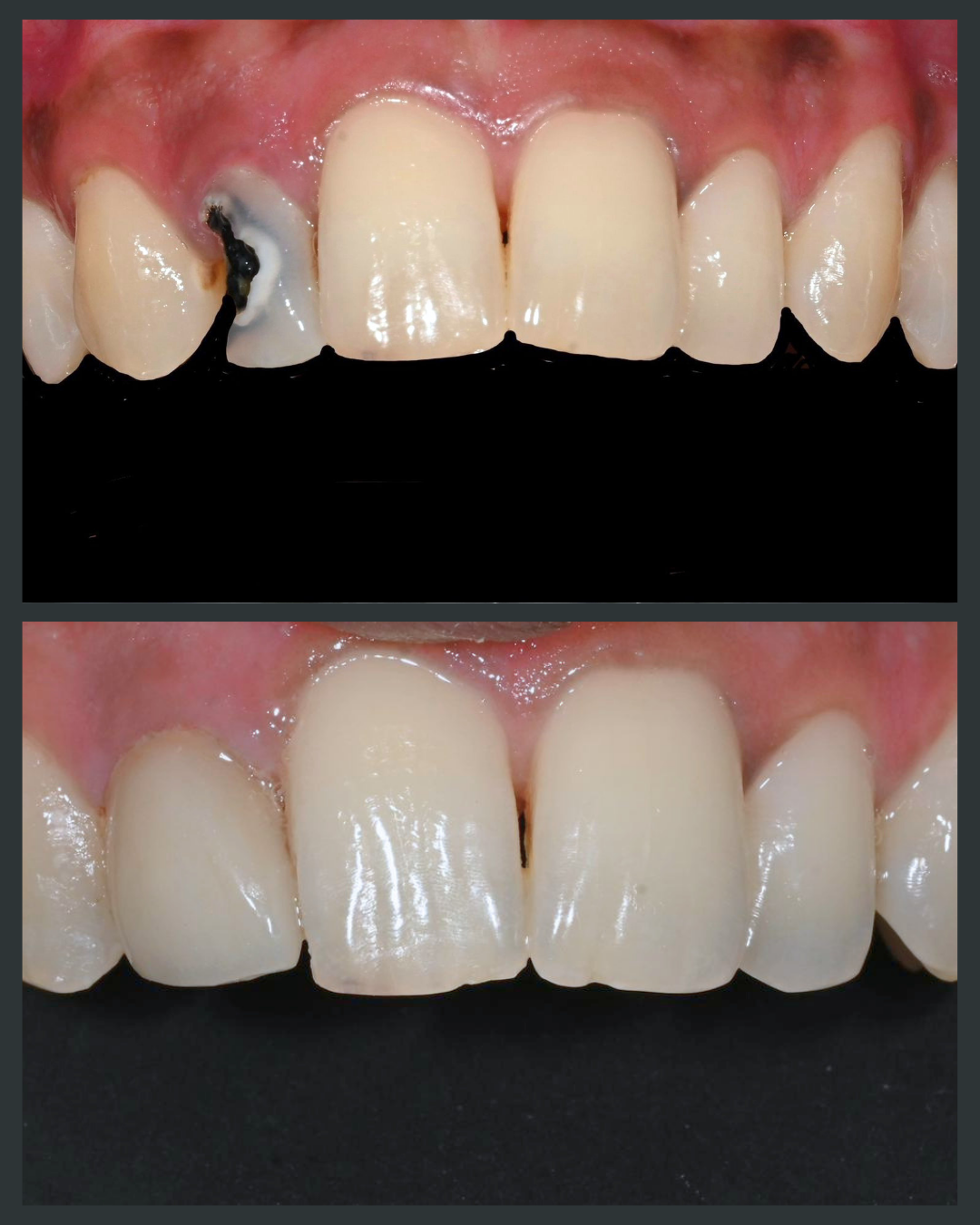 Veneers Before & After Result 20 at Floss-it Dental Clinic