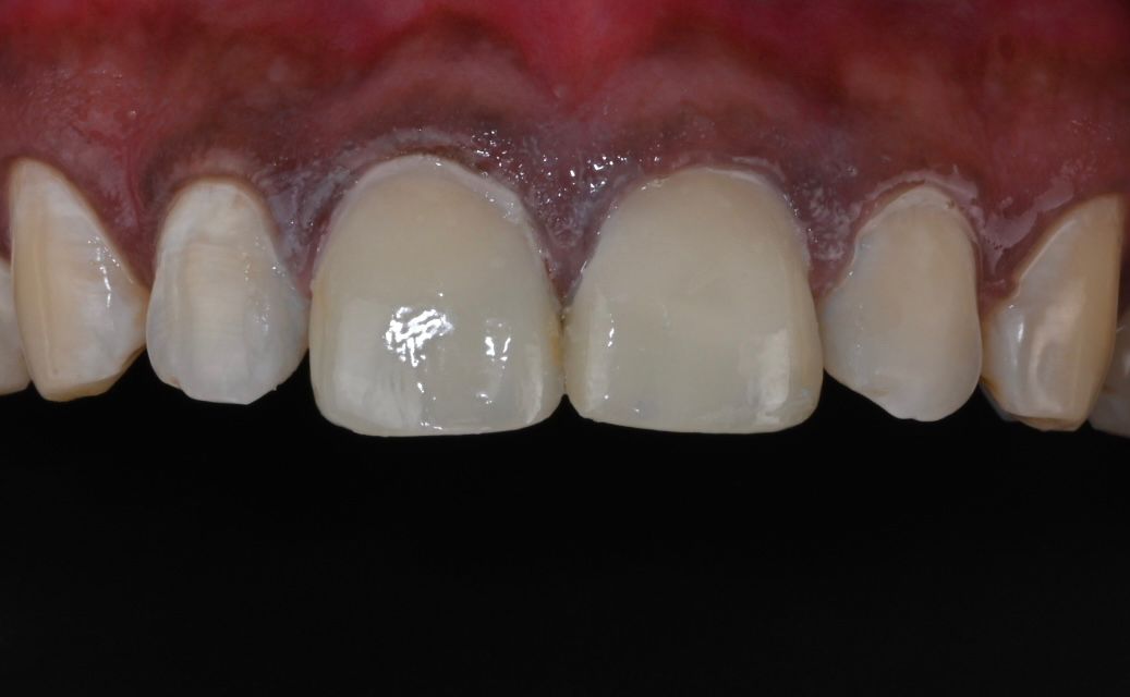 Case 1 after veneers treatment