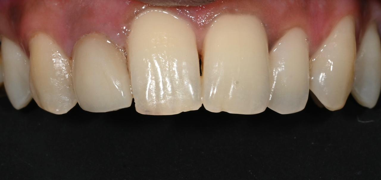Case 10 after veneers treatment