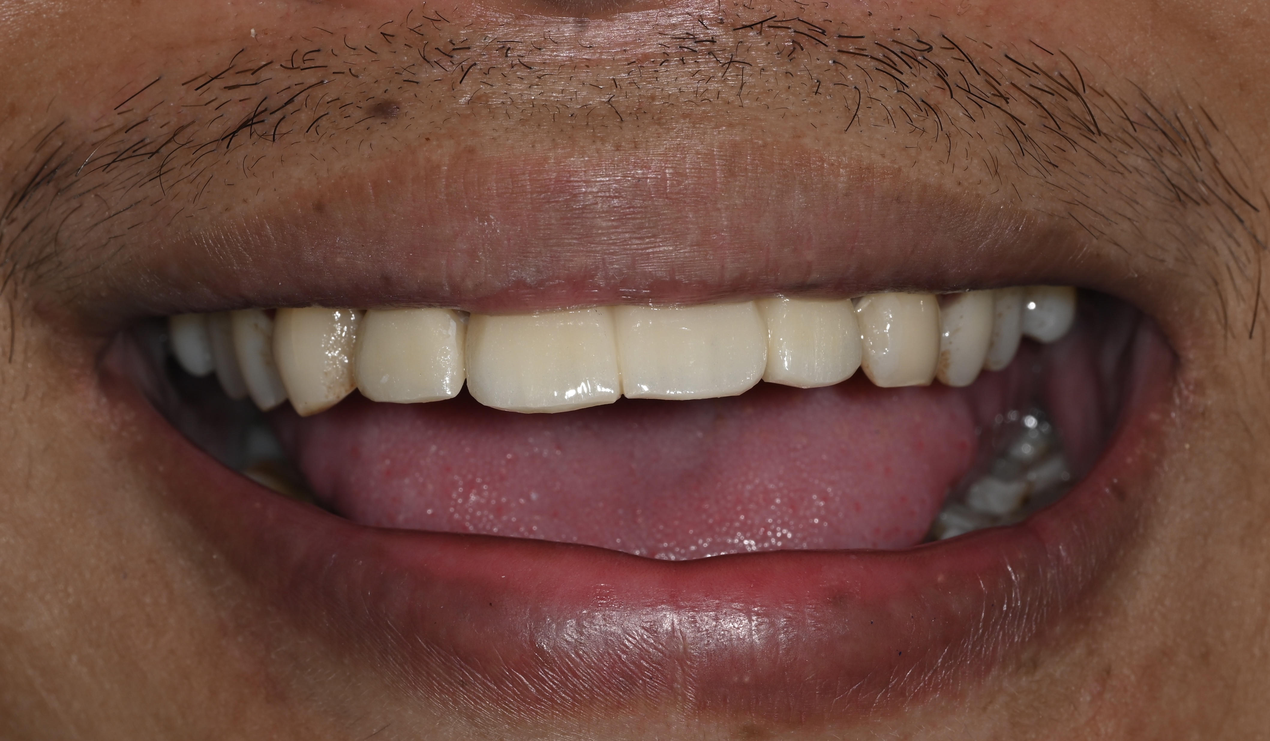 Case 11 after veneers treatment