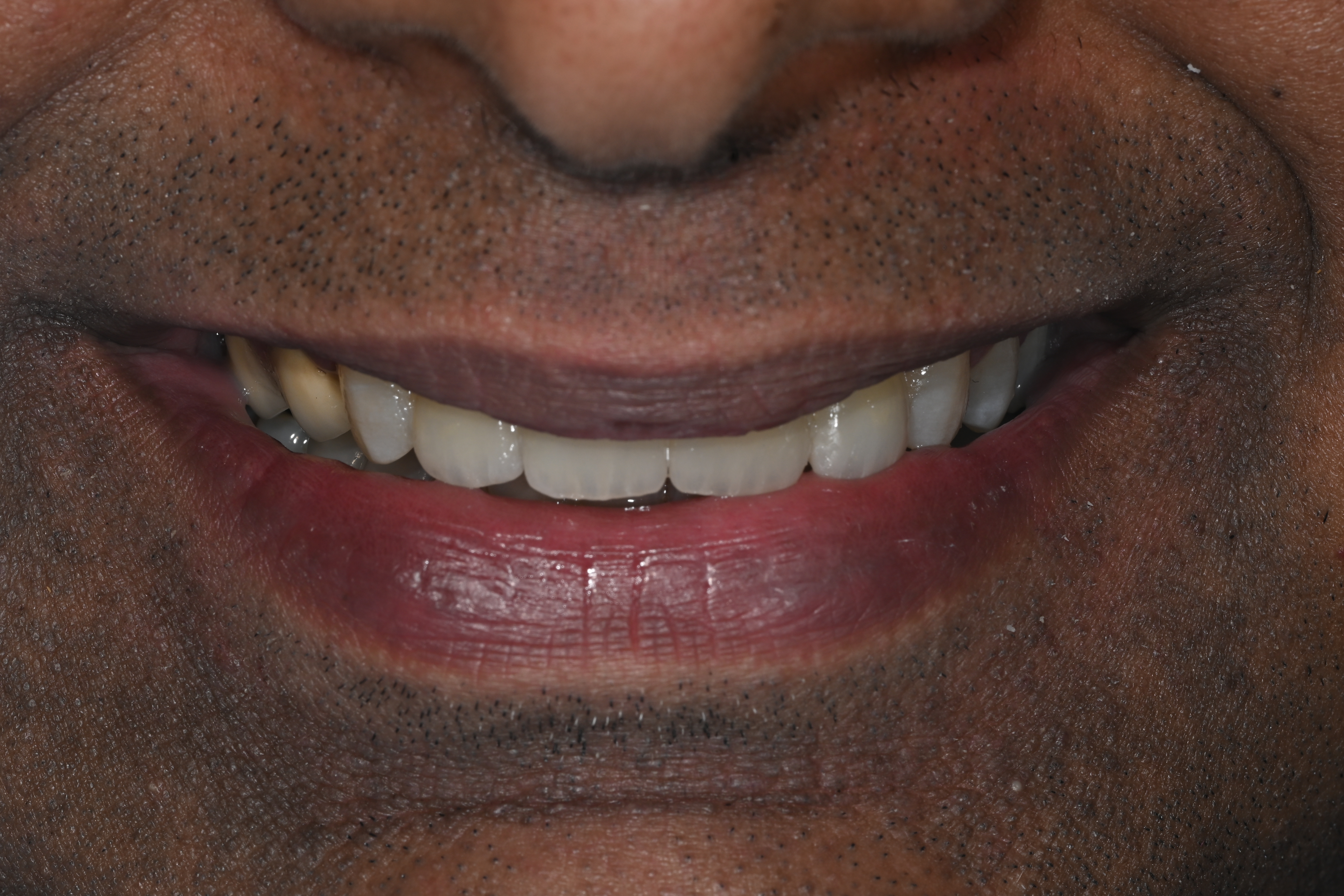 Case 2 after veneers treatment