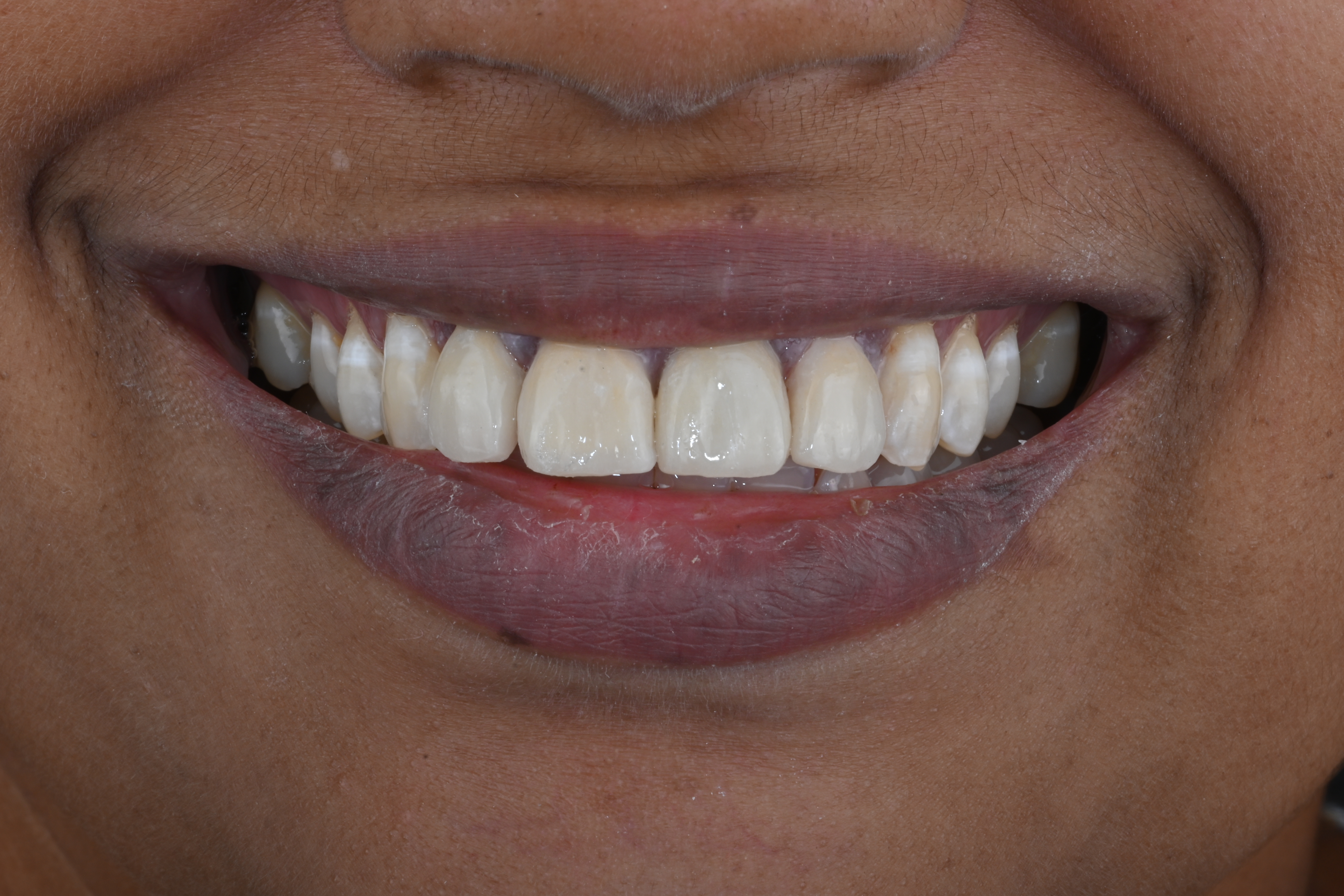 Case 4 after veneers treatment