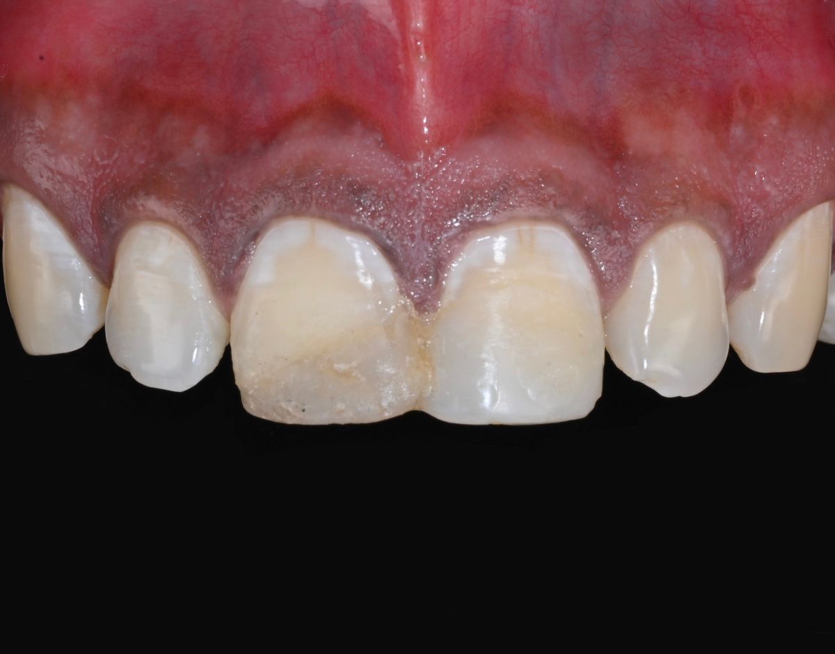 Case 1 before veneers treatment