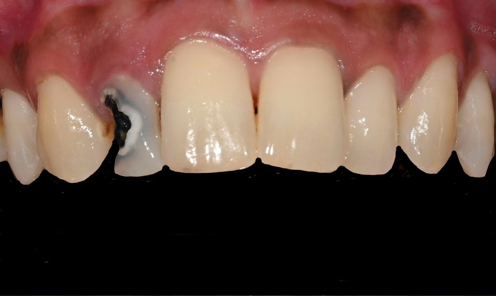 Case 10 before veneers treatment