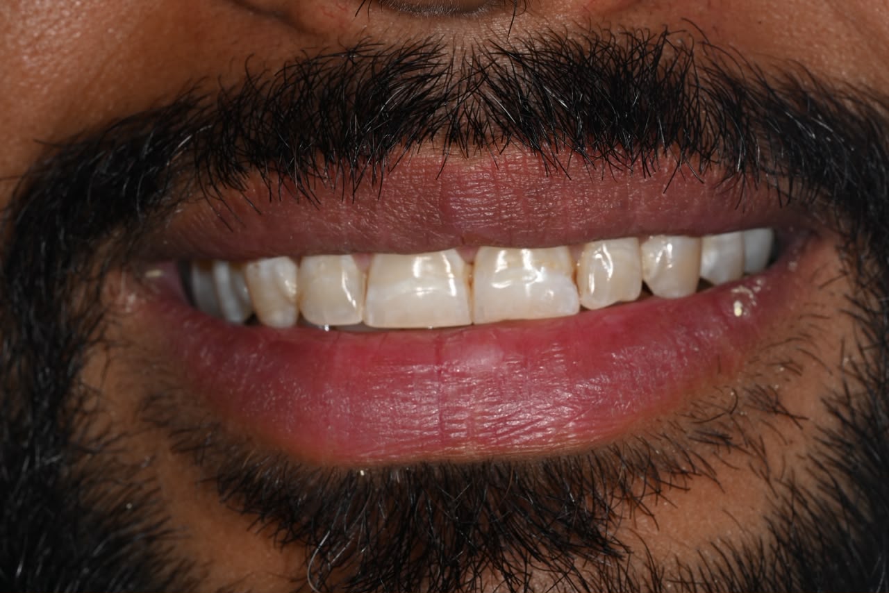 Case 12 before veneers treatment