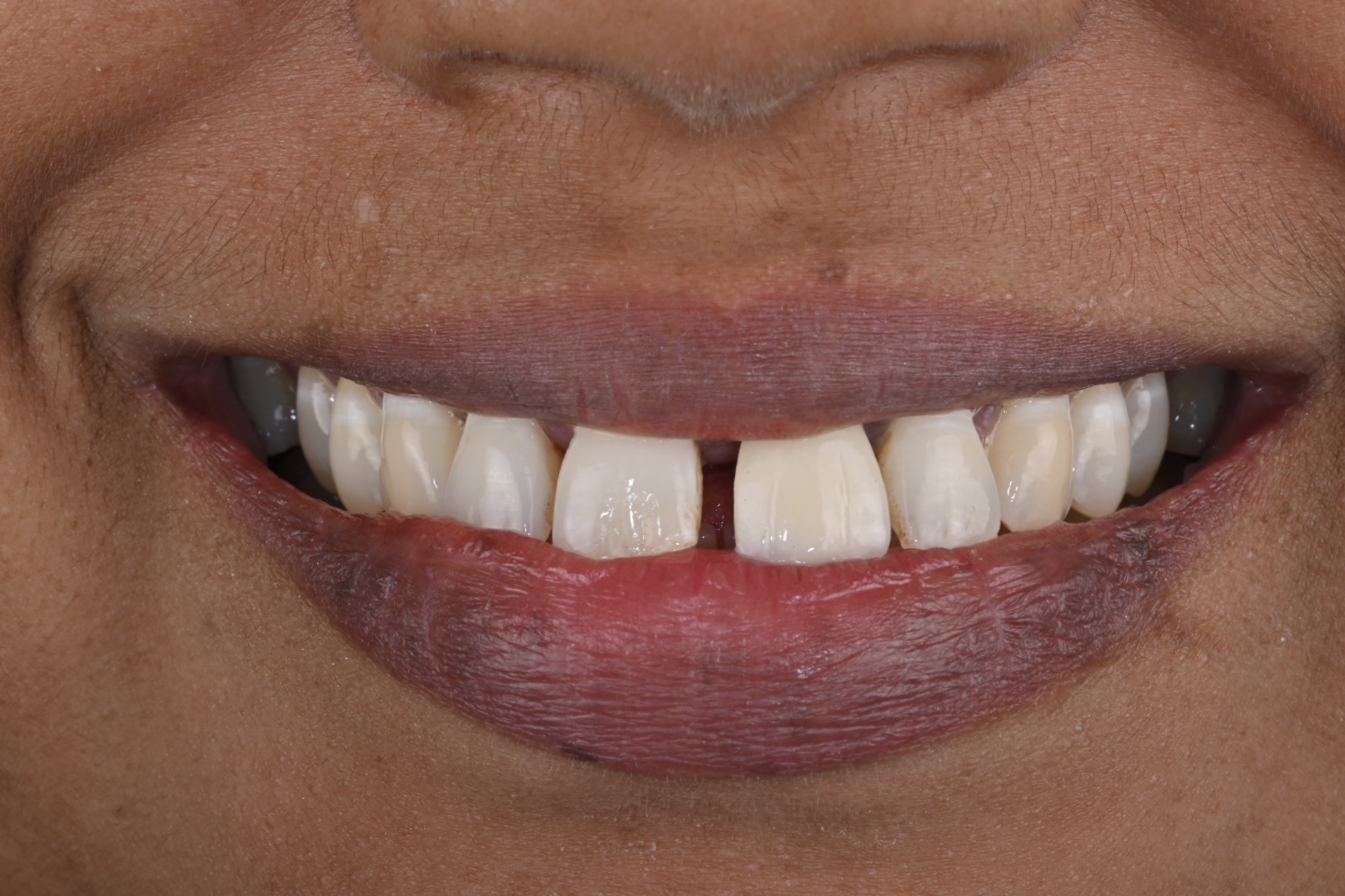 Case 4 before veneers treatment