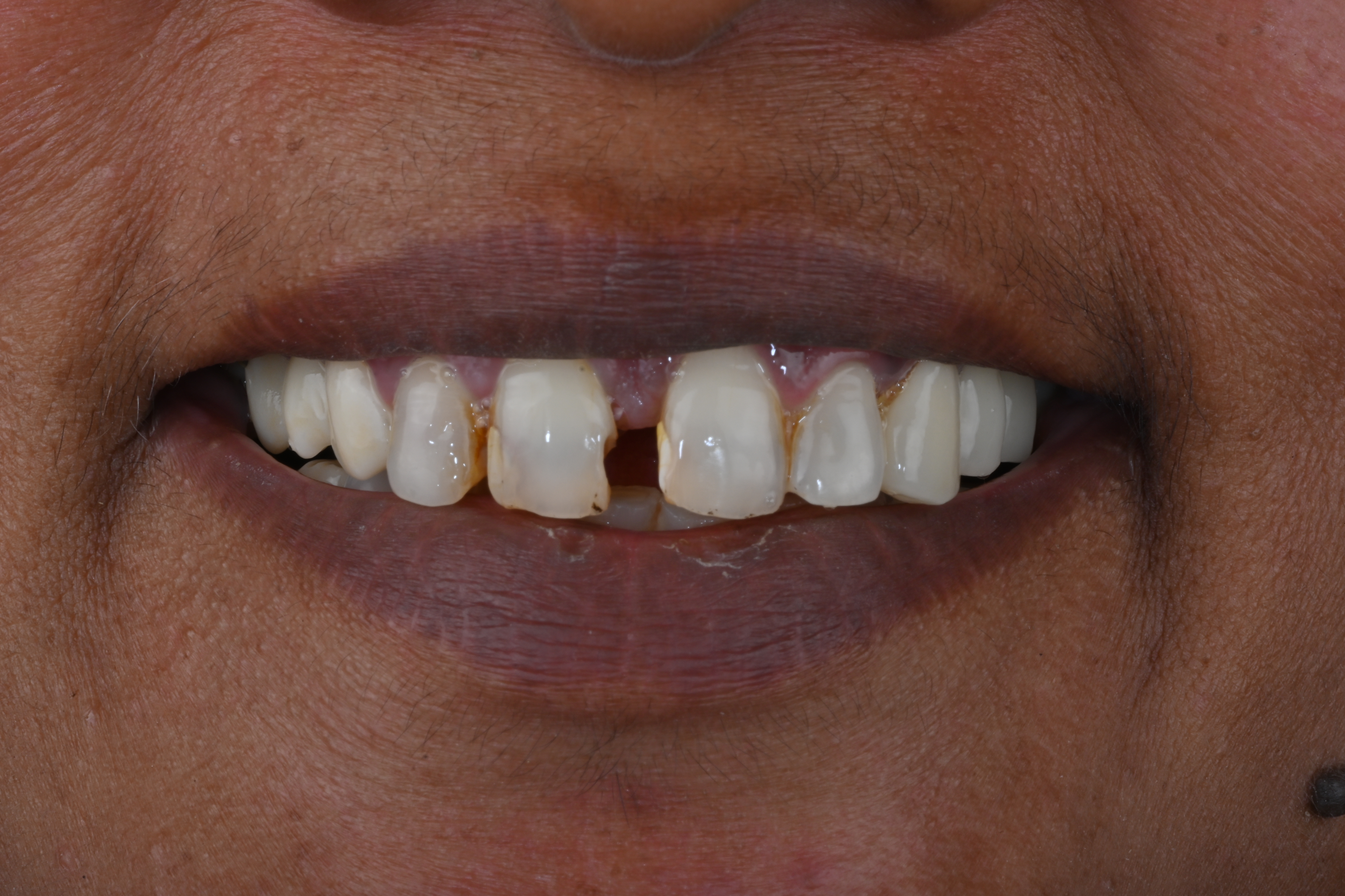 Case 5 before veneers treatment