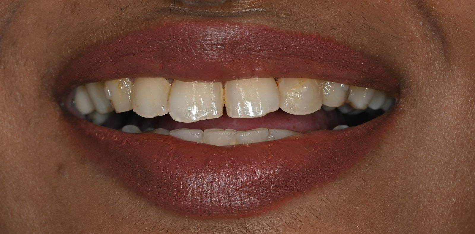 Case 6 before veneers treatment