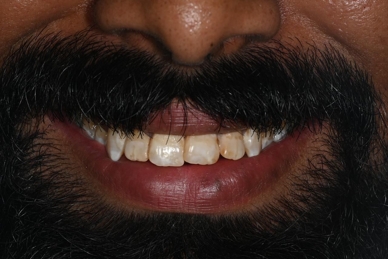 Case 7 before veneers treatment