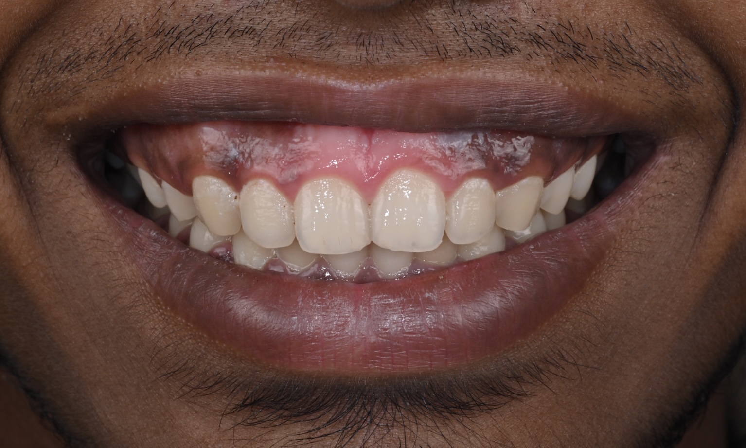 Case 8 before veneers treatment