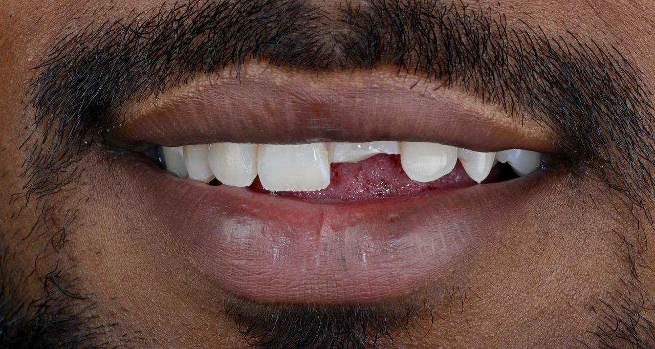 Case 9 before veneers treatment